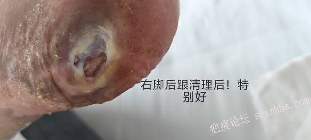 2025年李高令接治2023年低温烫伤的老人（青岛） 