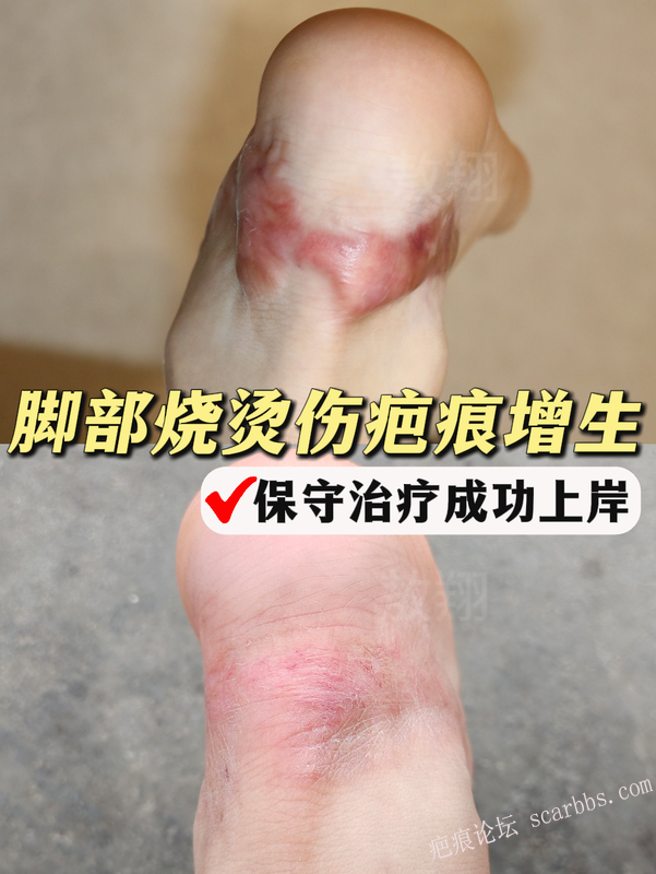 左足踝部的烧烫伤增生疤痕