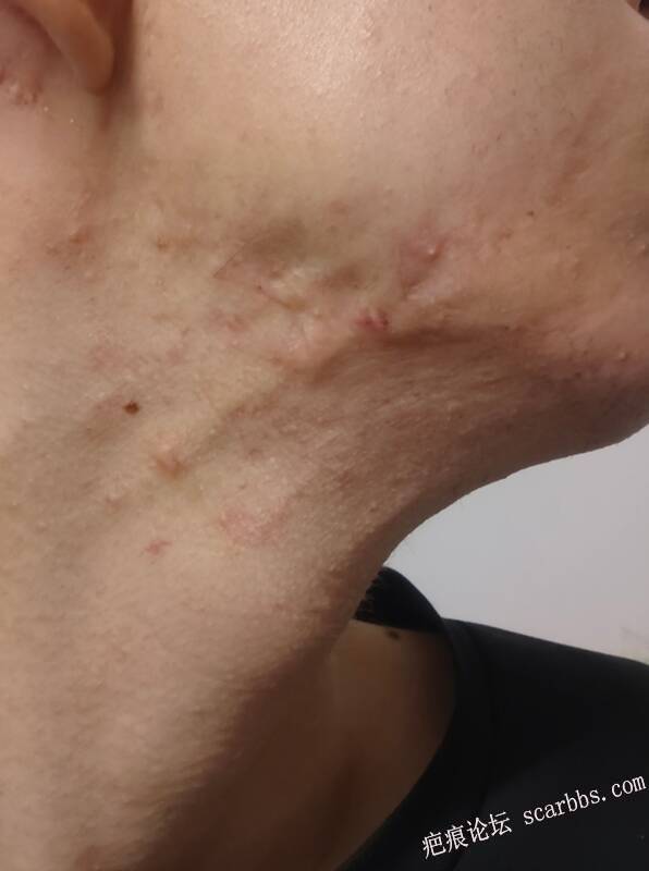 我这脸上的好严重脖子上也是 