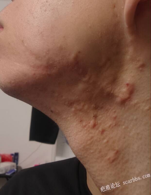 我这脸上的好严重脖子上也是