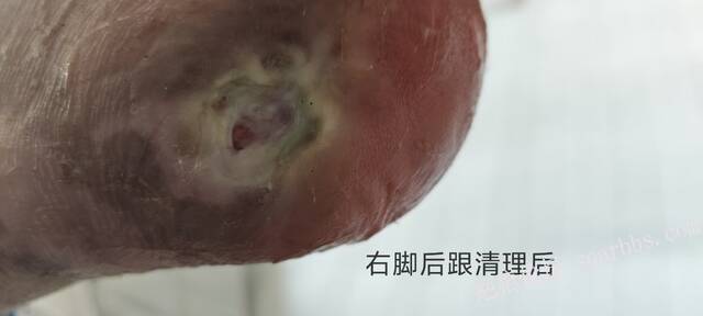 2025年李高令接治2023年低温烫伤的老人（青岛） 