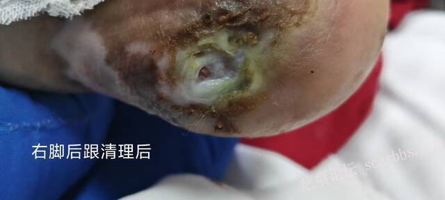 2025年李高令接治2023年低温烫伤的老人（青岛） 
