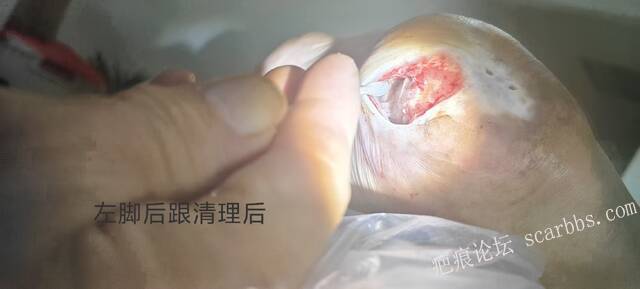 2025年李高令接治2023年低温烫伤的老人（青岛） 