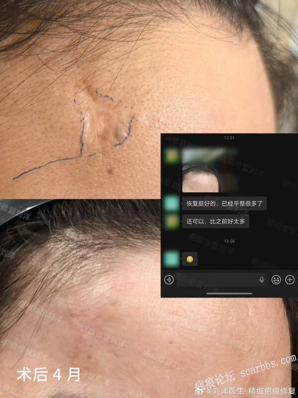 疤痕修复术后4个月