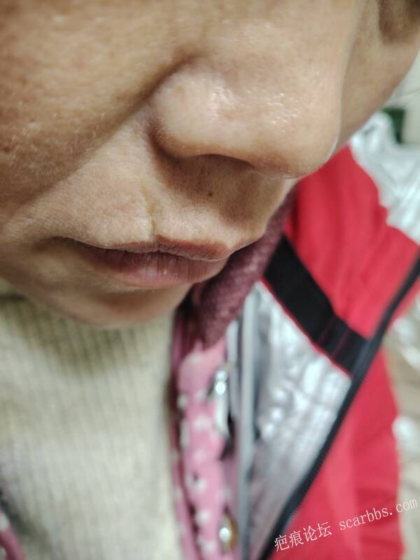 上唇凹陷疤痕，这个疤痕是小时候磕在锅边上，有三十多年了，虽然已经结婚，终究意难平