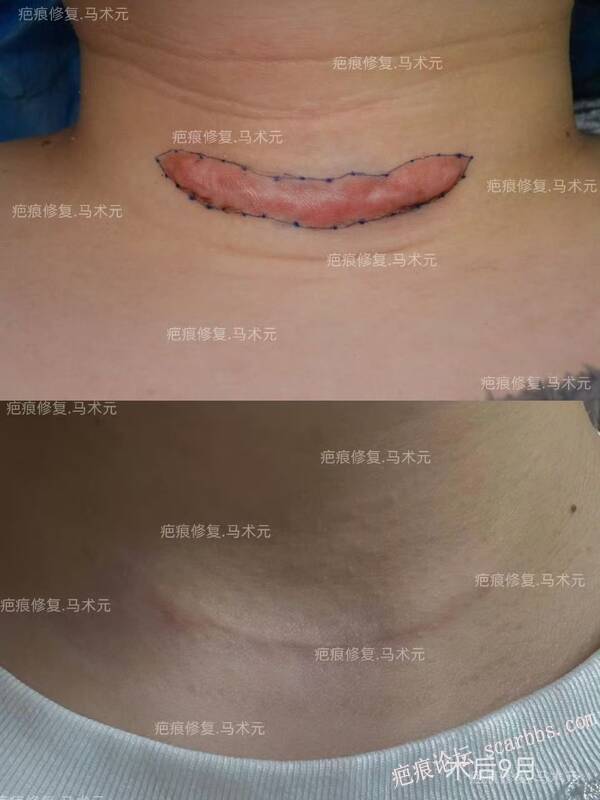 疤痕修复术后9个月