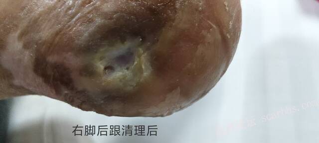 2025年李高令接治2023年低温烫伤的老人（青岛） 