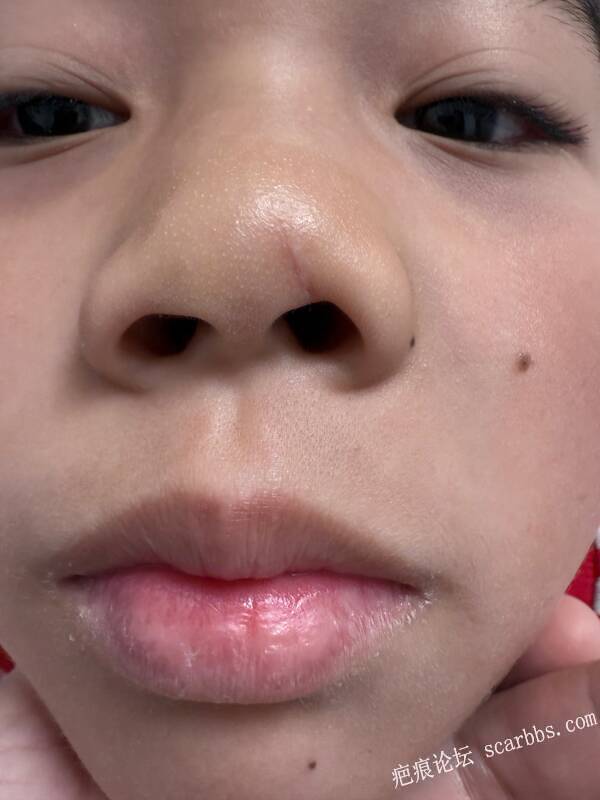 鼻子贯通伤，内外缝合疤