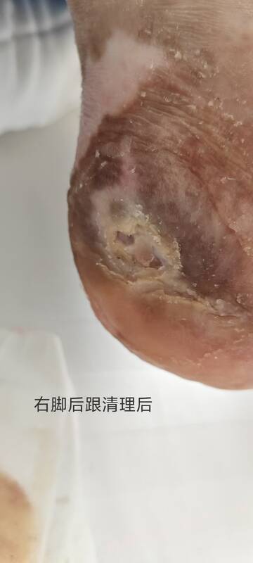 2025年李高令接治2023年低温烫伤的老人（青岛） 