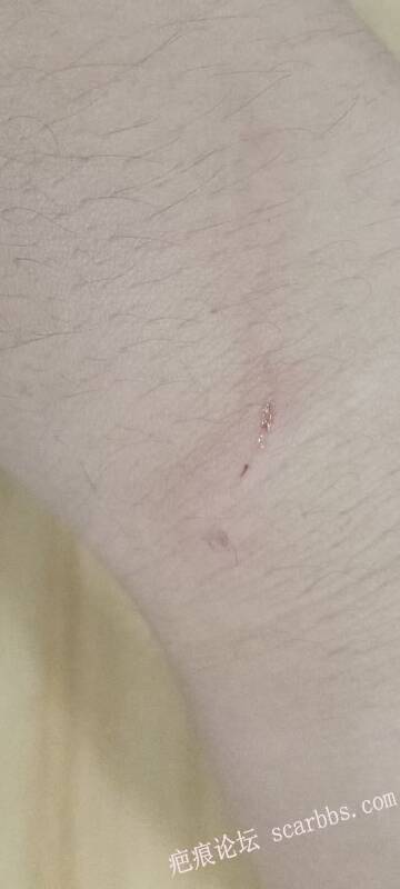 被抓伤想问问会不会留疤