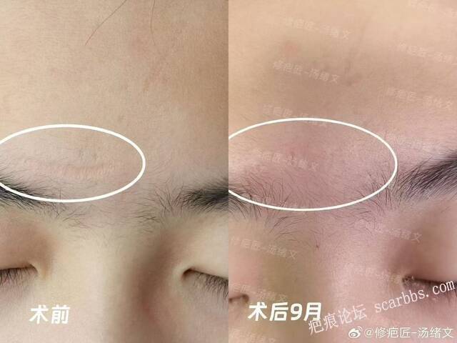 疤痕修复术后9个月啦
