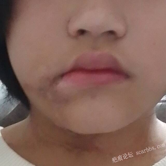 面部16年陈年烫伤疤痕 