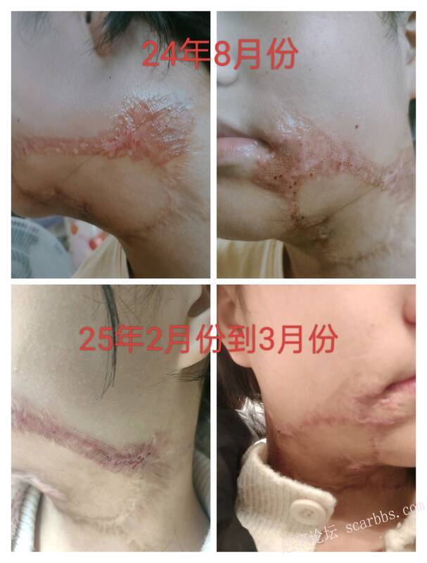 面部16年陈年烫伤疤痕 