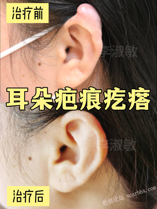 打耳洞后增生疤痕疙瘩，有多少人和她一样？