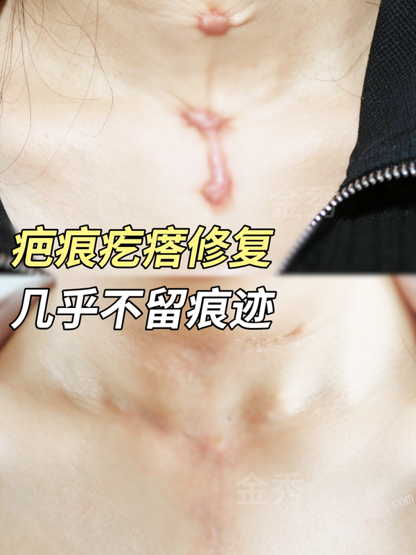 脖子上长了疤痕疙瘩？拖不得！