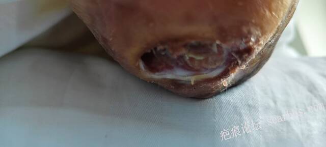 2025年李高令接治2023年低温烫伤的老人（青岛） 