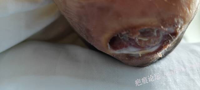 2025年李高令接治2023年低温烫伤的老人（青岛） 