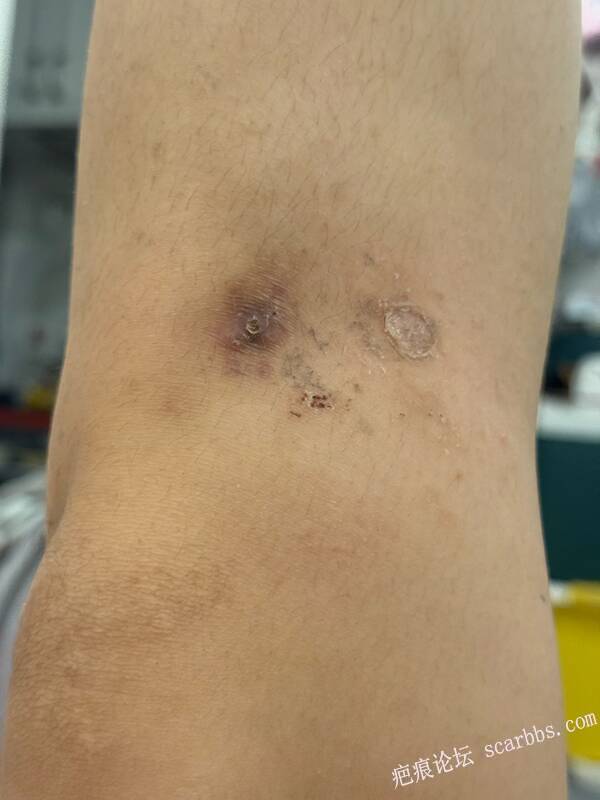 膝盖部位外伤，求助！！！