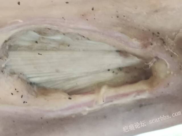 2025年李高令接治2023年低温烫伤的老人（青岛） 