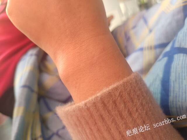 手上的疤还怎么去掉