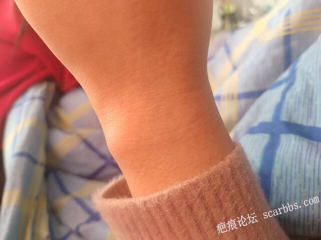 手上的疤还怎么去掉 