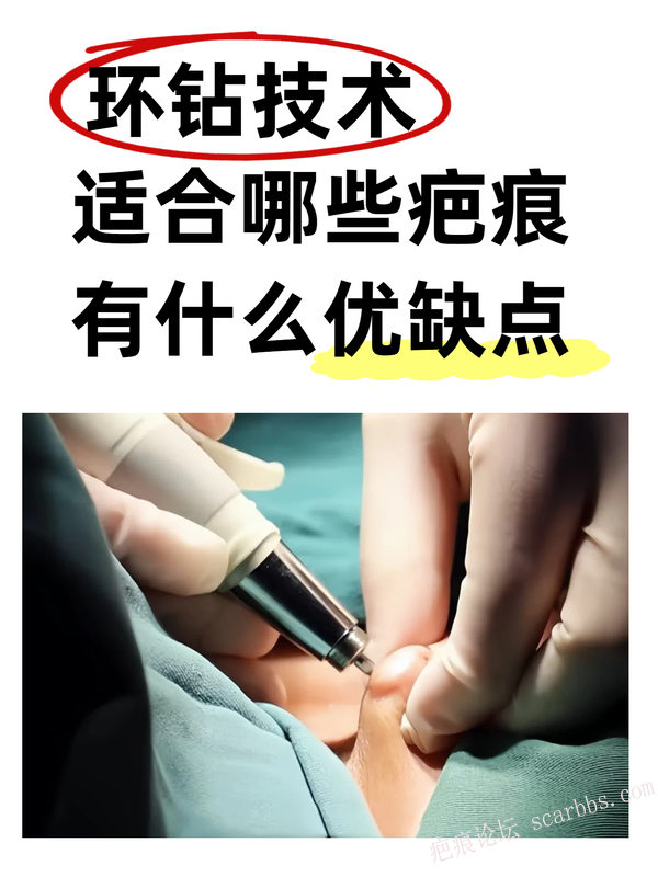 别盲目祛疤！环钻适合哪些疤痕？