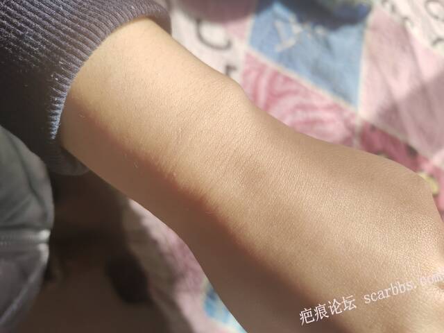 手上的疤还怎么去掉 