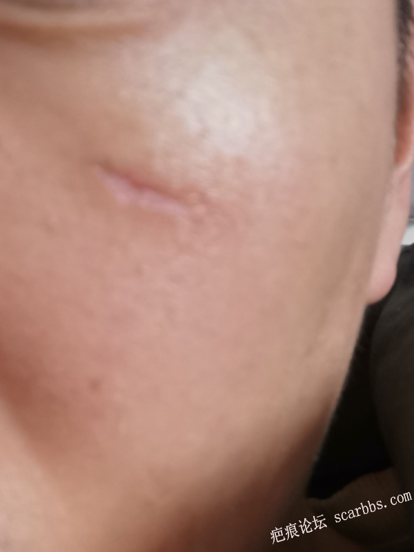 脸上意外划伤，伤口比较深