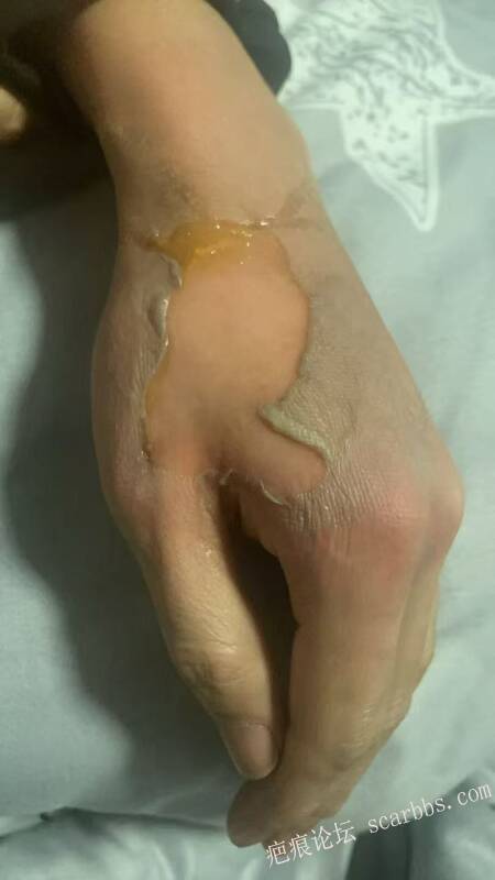 李高令接治又一个受伤的患者(青岛) 