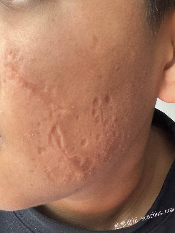 孩子脸上药物烧伤，做了三次切除手术 