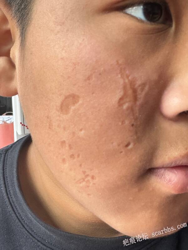 孩子脸上药物烧伤，北京做了三次切除手术，还是不理想，去你们有什么好的治疗方案吗。