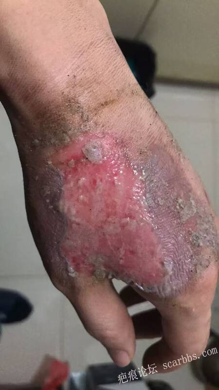 李高令接治又一个受伤的患者(青岛) 