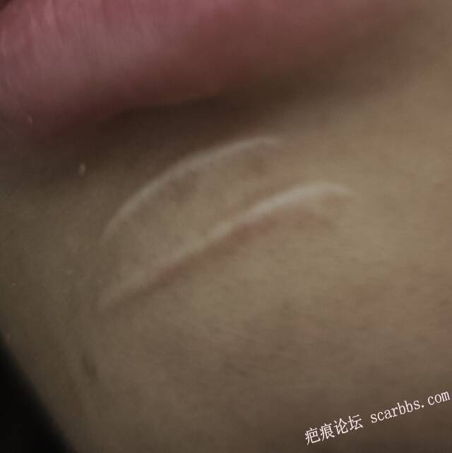 下颌处15年陈旧瘢痕 