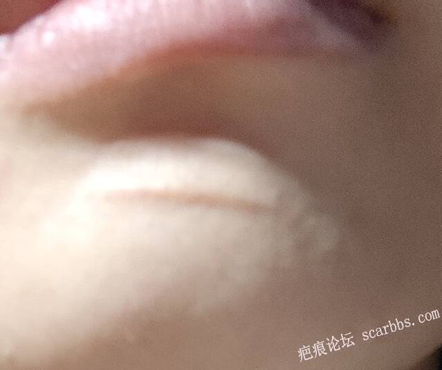 下颌处15年陈旧瘢痕 