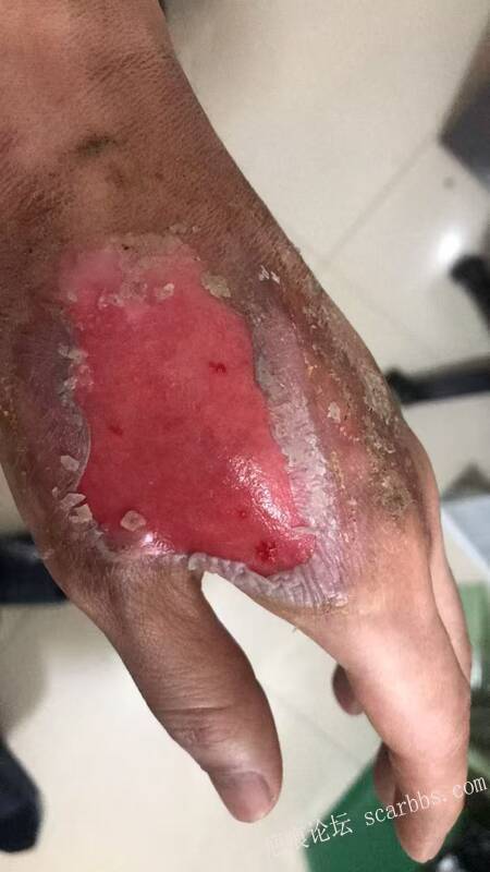 李高令接治又一个受伤的患者(青岛) 