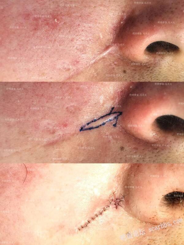 疤痕修复有必要改型吗？