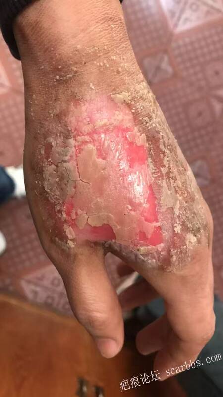 李高令接治又一个受伤的患者(青岛) 