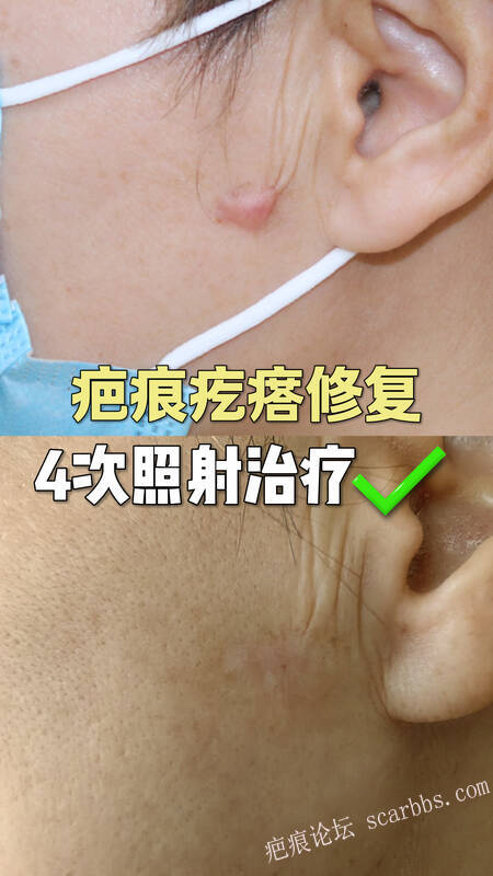 疤痕疙瘩修復(fù)｜4 次照射治療搞定