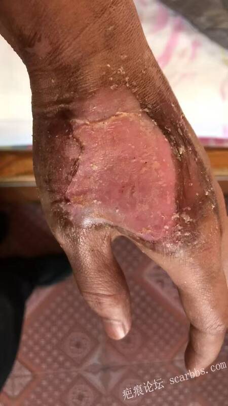 李高令接治又一个受伤的患者(青岛) 