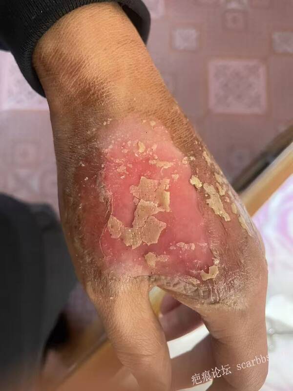 李高令接治又一个受伤的患者(青岛) 