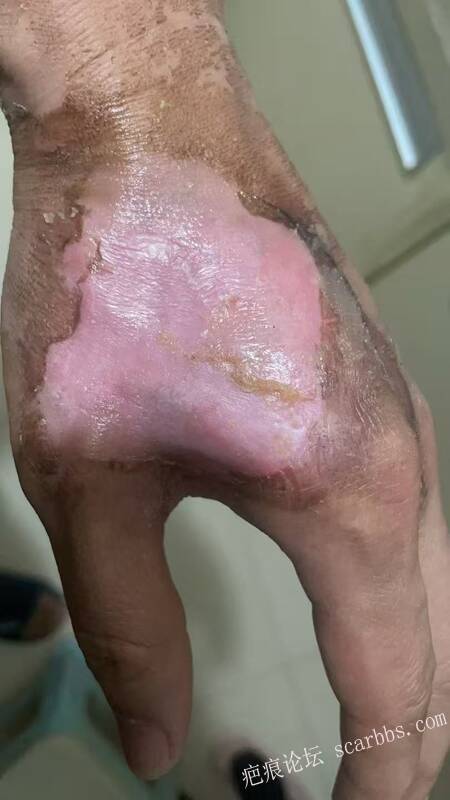 李高令接治又一个受伤的患者(青岛) 