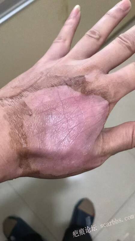 李高令接治又一个受伤的患者(青岛) 