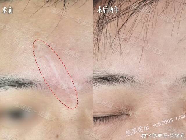 眉間疤痕切除縫合術(shù)后兩年