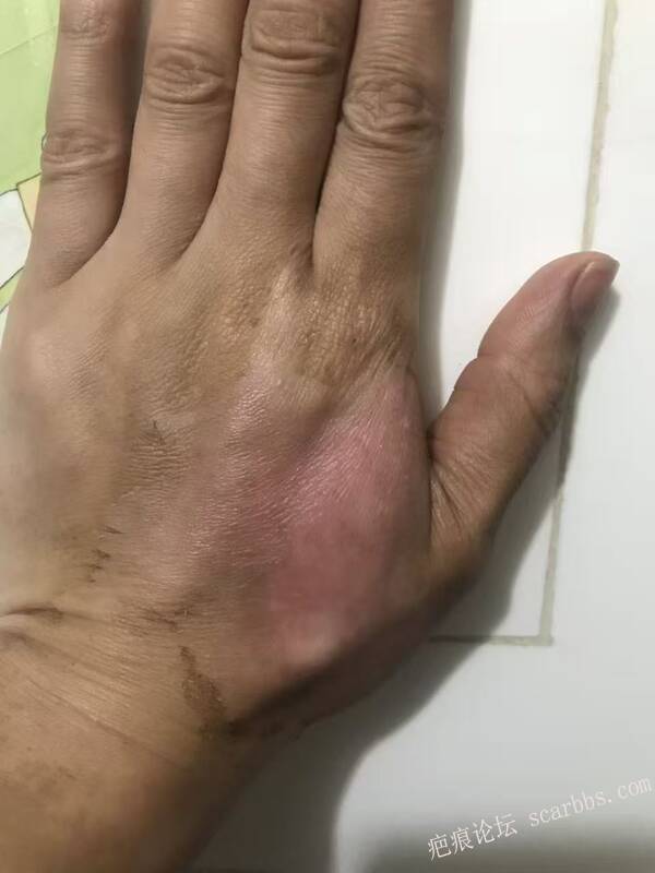 李高令接治又一个受伤的患者(青岛) 