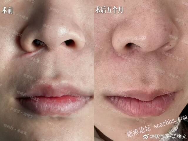 疤痕手术术后5个月啦