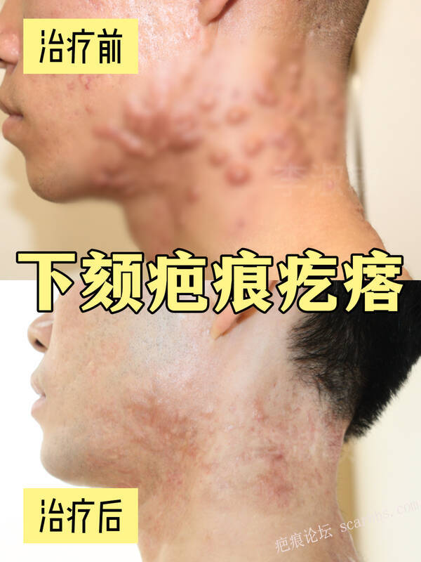 有没有人下颏、颈部密密麻麻长满了疤痕疙瘩⁉️ · 视频里这位患者就是，双侧下颏、颈