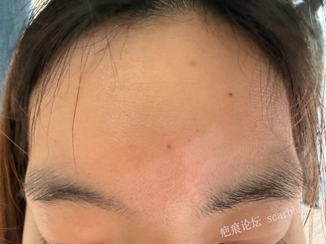 女儿1岁时额头磕坏留疤了，2025年3月30日找陈立彬医生重新切缝 