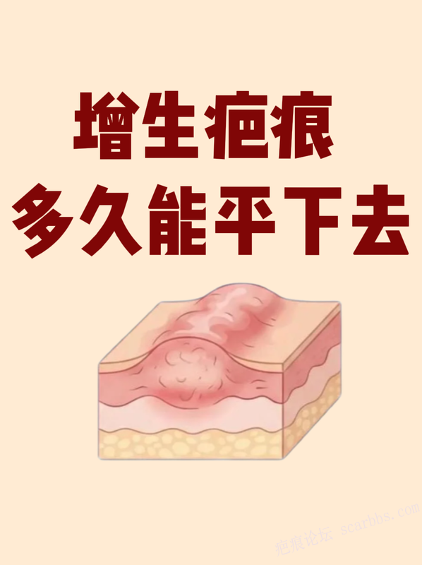 增生疤痕多久能消？