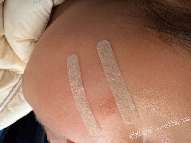 儿童指甲抓伤一个月凹陷