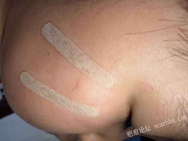 儿童指甲抓伤一个月凹陷 